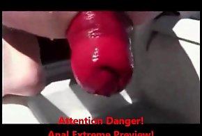 Extreme anal fisting